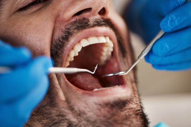 Best Emergency Dentist for Lost Fillings or Crowns in , TX